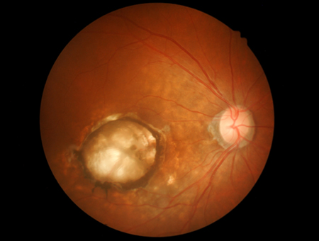 Retinal scan showing macular degeneration