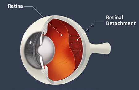 Illustration showing Retinal Detachment