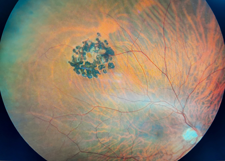 Retinal scan showing laser treatment of retinal hole