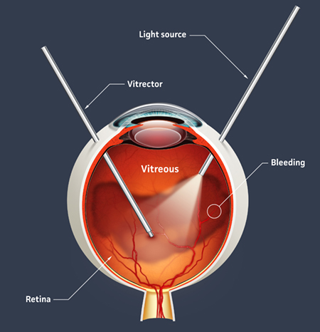 Illustration of vitrectomy procedure